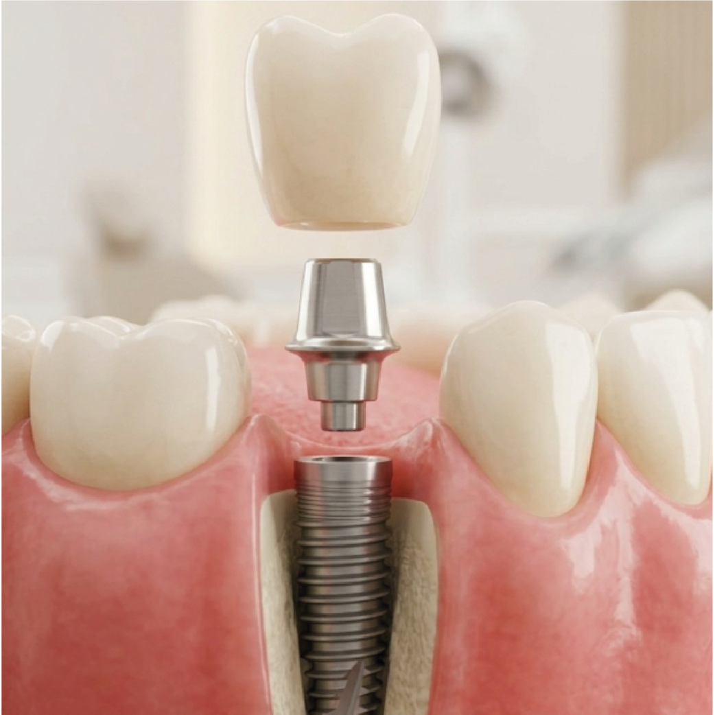 Implantes dentales 1